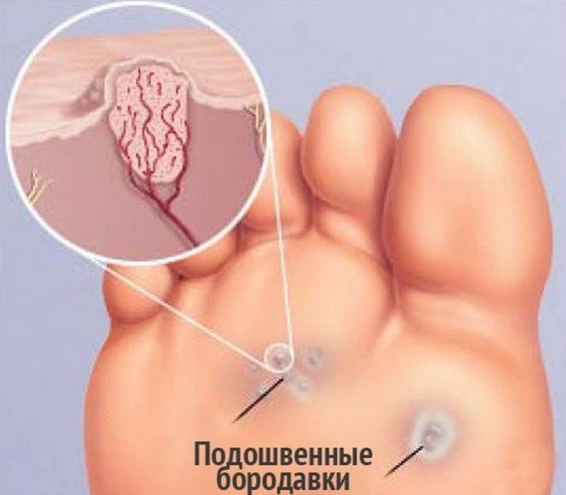 Подошвенная бородавка